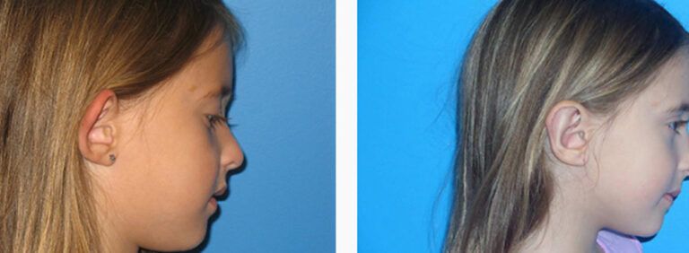 Otoplasty before and after treatment
