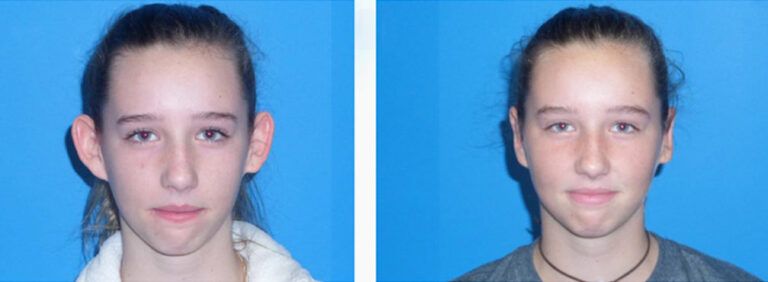 Otoplasty before and after treatment
