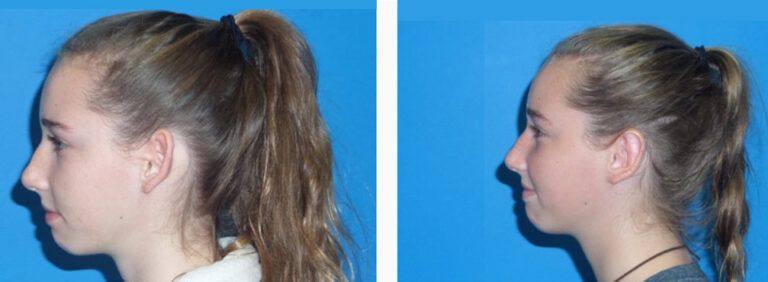 Otoplasty before and after treatment