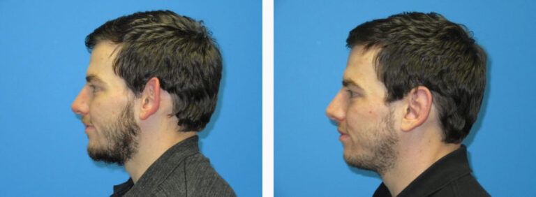 Otoplasty before and after treatment