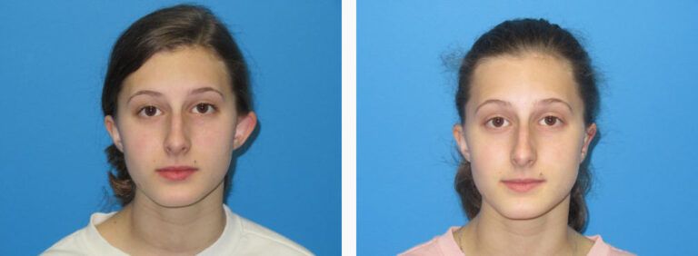 Otoplasty before and after treatment