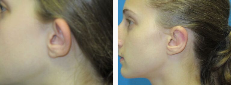 Otoplasty before and after treatment