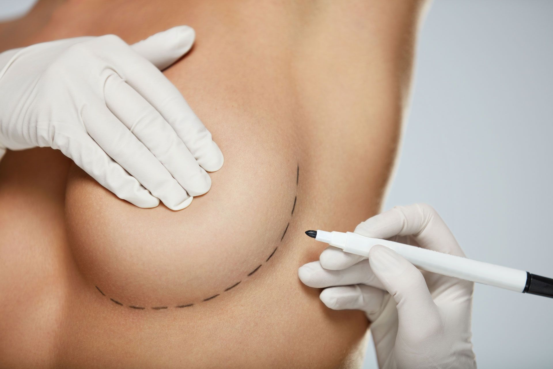 Doctor Hands Drawing Lines On Female Breast Before Breast Augmentation