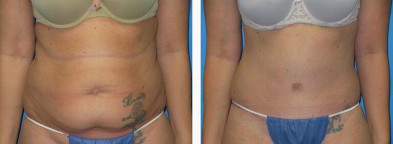 Abdominoplasty before and after treatment