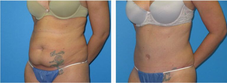 Abdominoplasty before and after treatment