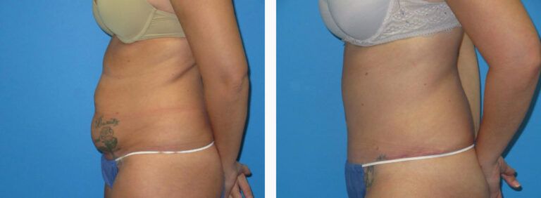 Abdominoplasty before and after treatment