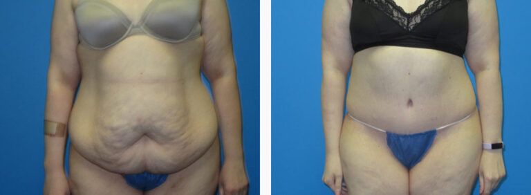 Abdominoplasty before and after treatment