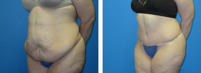 Abdominoplasty before and after treatment