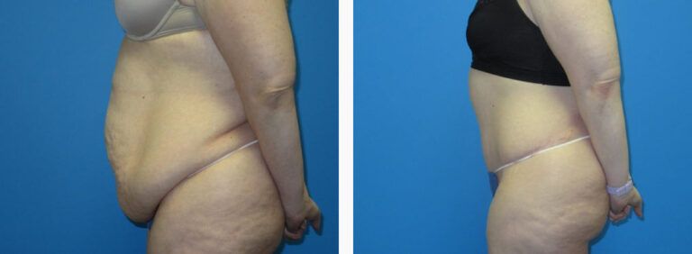 Abdominoplasty before and after treatment