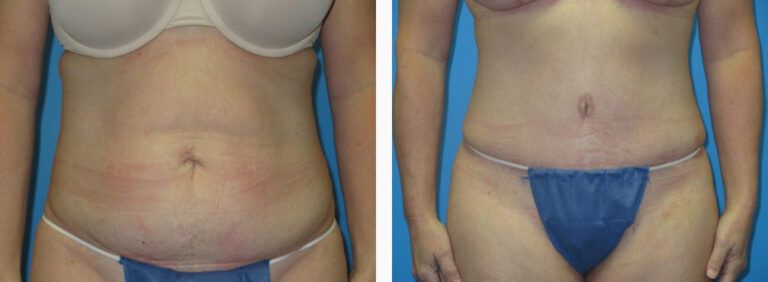 Abdominoplasty before and after treatment
