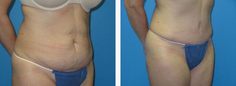 Abdominoplasty before and after treatment