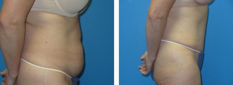 Abdominoplasty before and after treatment