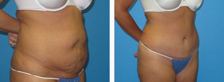 Abdominoplasty before and after treatment