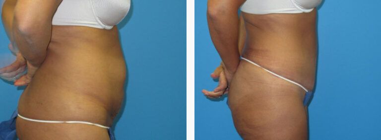 Abdominoplasty before and after treatment