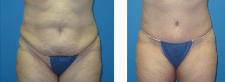 Abdominoplasty before and after treatment