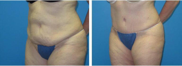 Abdominoplasty before and after treatment