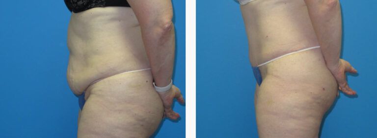 Abdominoplasty before and after treatment