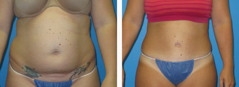 Abdominoplasty before and after treatment