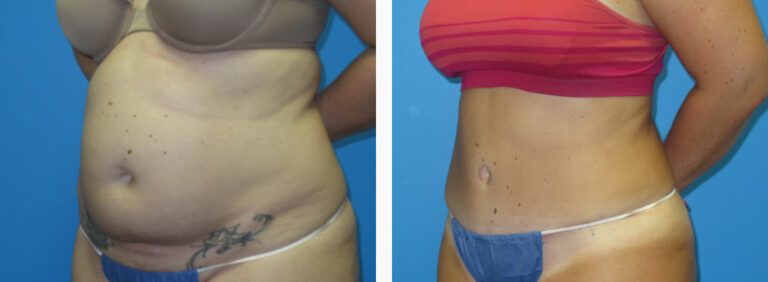 Abdominoplasty before and after treatment