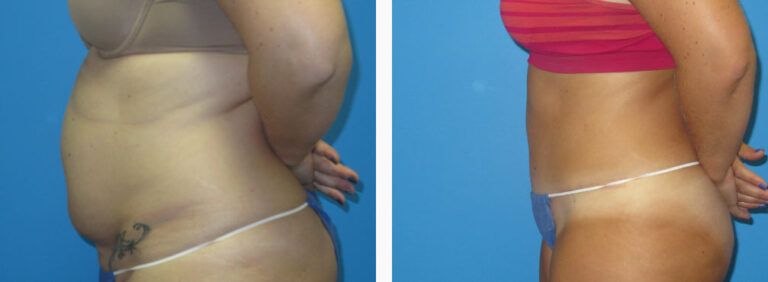 Abdominoplasty before and after treatment