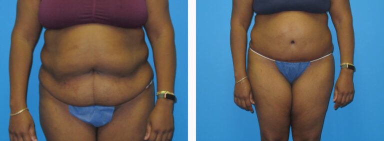 Abdominoplasty before and after treatment