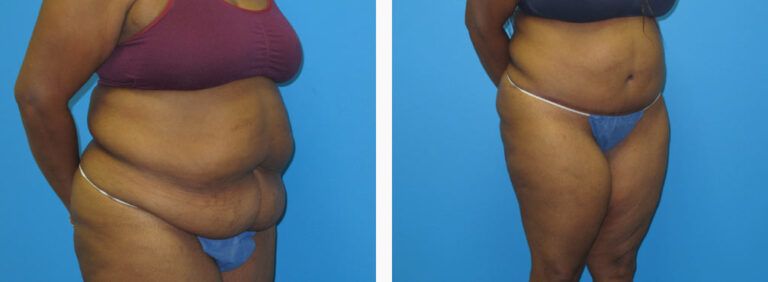 Abdominoplasty before and after treatment