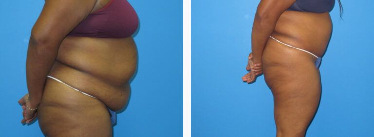 Abdominoplasty before and after treatment