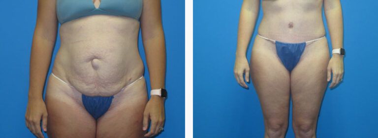Abdominoplasty before and after treatment