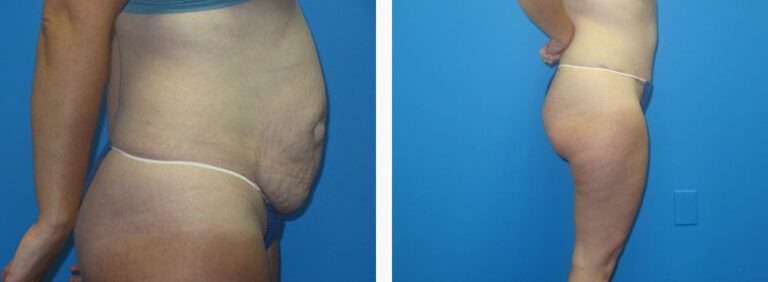 Abdominoplasty before and after treatment
