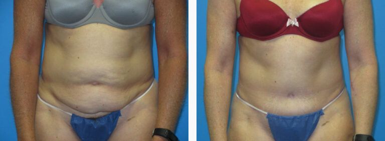 Abdominoplasty before and after treatment