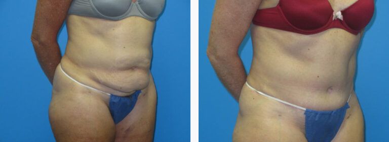 Abdominoplasty before and after treatment