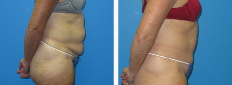 Abdominoplasty before and after treatment