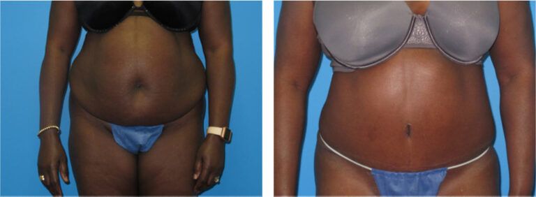 Abdominoplasty before and after treatment