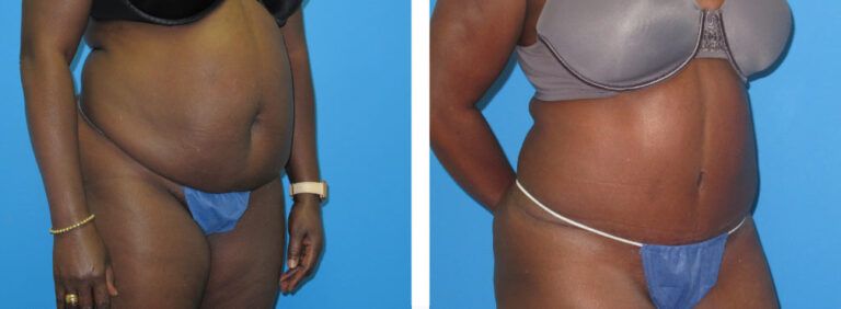 Abdominoplasty before and after treatment