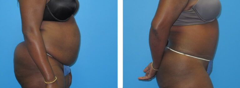 Abdominoplasty before and after treatment