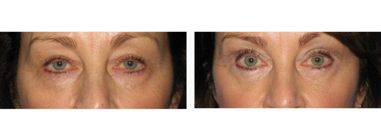 Blepharoplasty before and after treatment