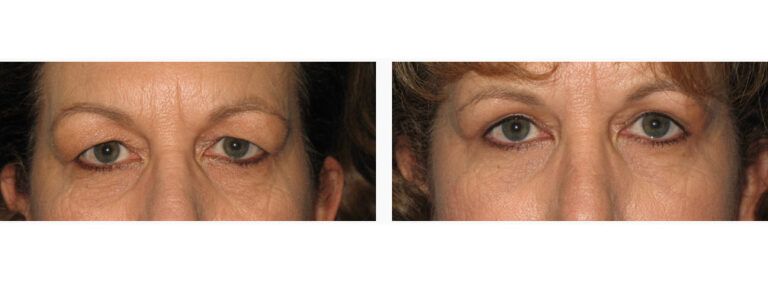 Blepharoplasty before and after treatment