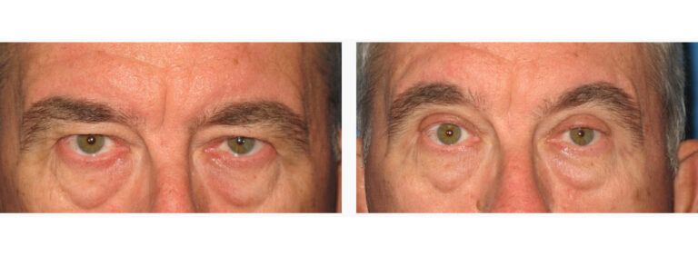 Blepharoplasty before and after treatment