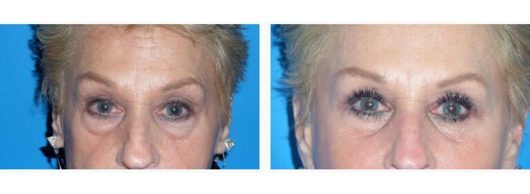 Blepharoplasty before and after treatment