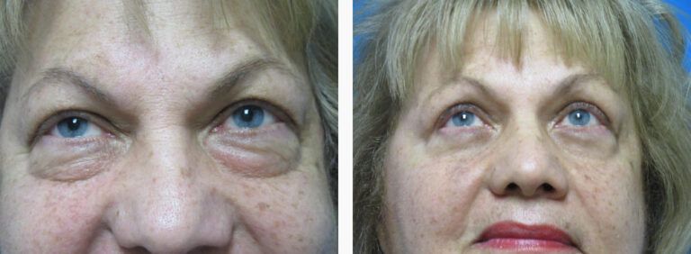 Blepharoplasty before and after treatment