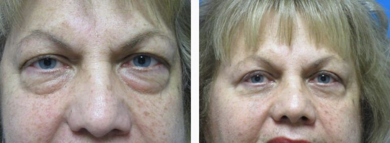 Blepharoplasty before and after treatment