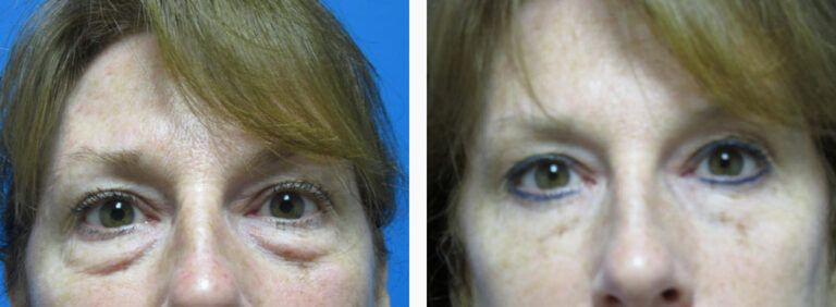 Blepharoplasty before and after treatment