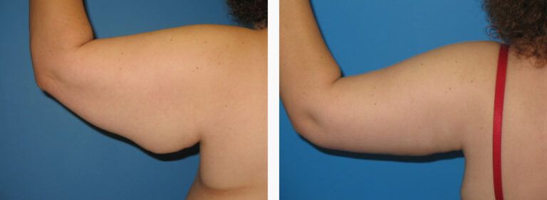 Brachioplasty before and after treatment