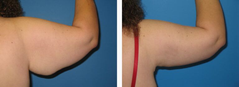 Brachioplasty before and after treatment