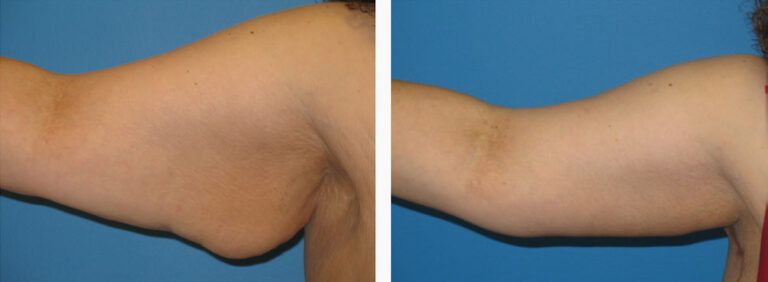 Brachioplasty before and after treatment