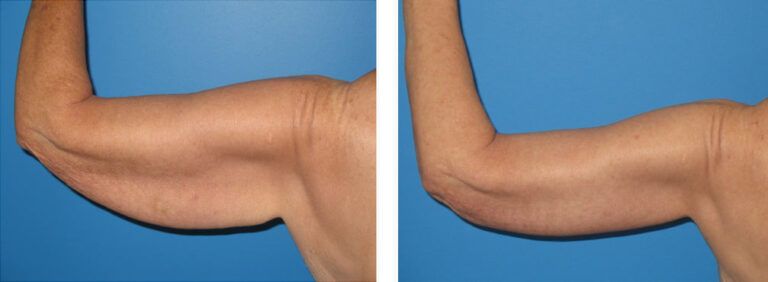 Brachioplasty before and after treatment