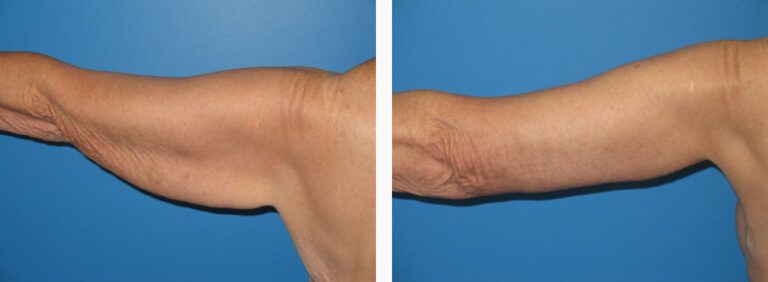 Brachioplasty before and after treatment