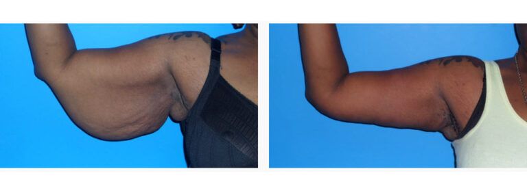 Brachioplasty before and after treatment