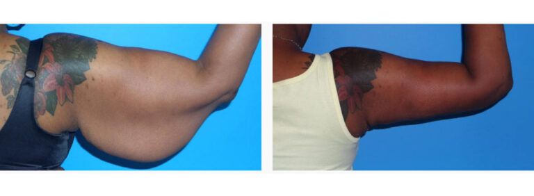 Brachioplasty before and after treatment