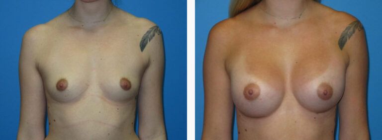 Breast Augmentation before and after treatment